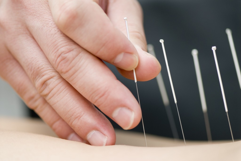 Doctor uses needles for treatment of the patient. acupuncture needles. alternative healthcare